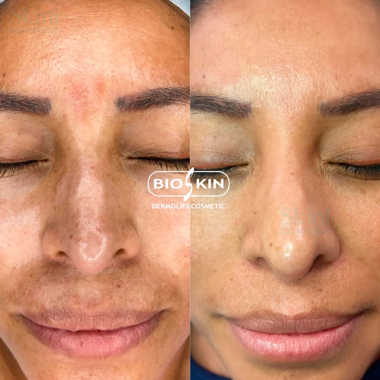 BSK14 Tranex Pro – Skin Tone Balancing Solution (5 Vials x 5 mL)