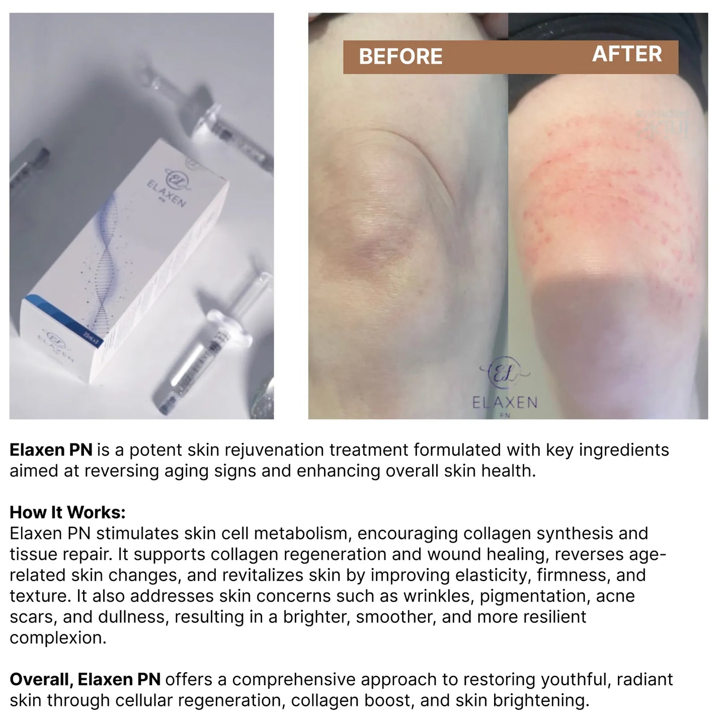 Elaxen PN | Korean Skin Booster | 2.2ml x 3 SYRINGES
