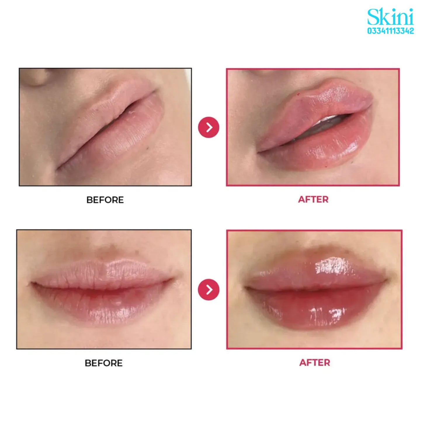 Tesoro Rouge Lip FIller - 1 × 1.1mL Pre-filled Syringe