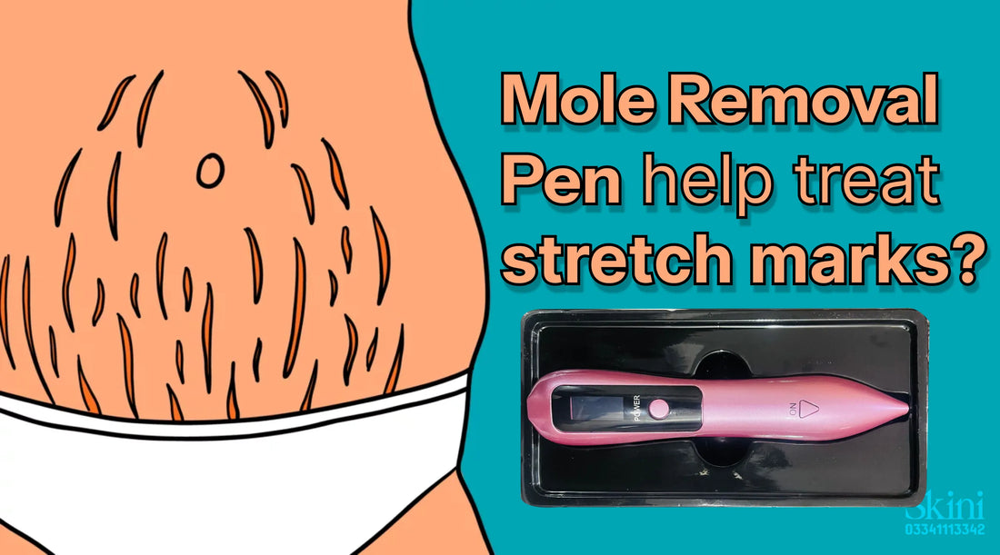 Can a Mole Removal Pen help treat stretch marks?