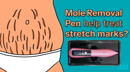 Can a Mole Removal Pen help treat stretch marks?
