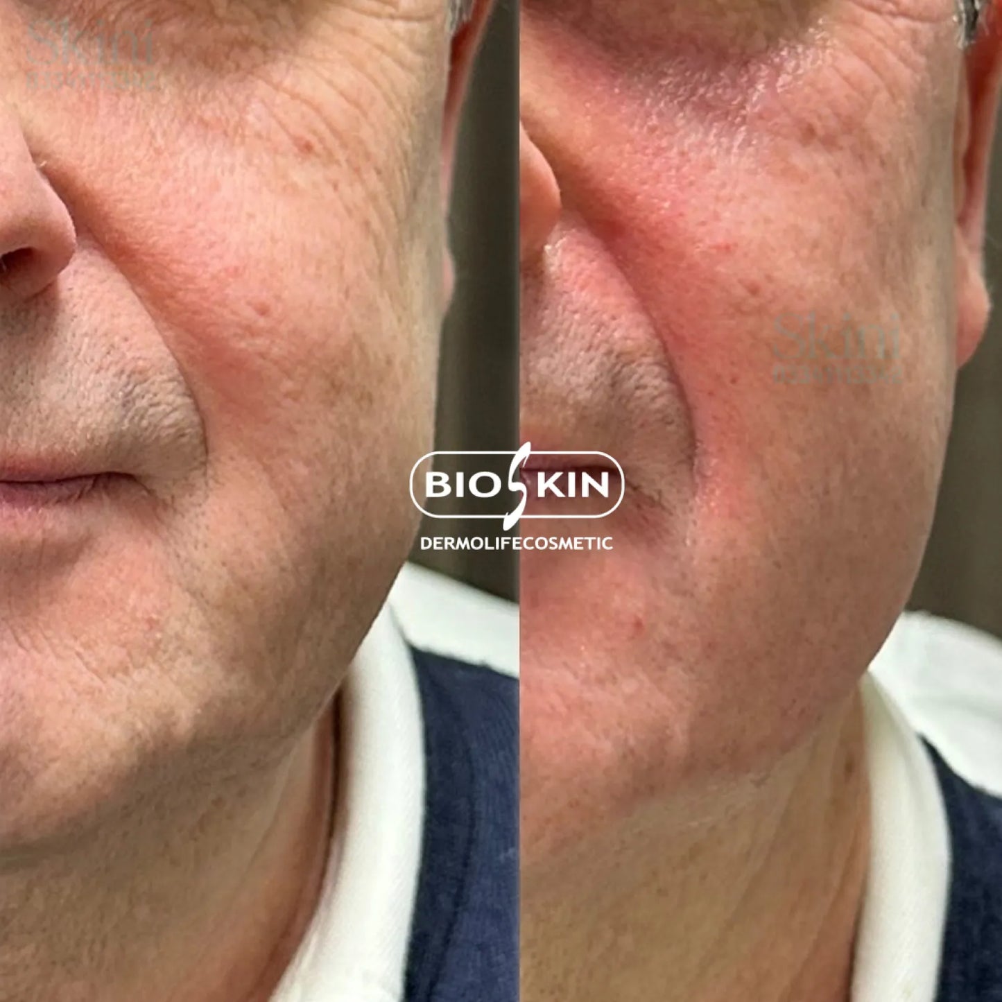 BSK1 Multipeptides HA – Bio-Revitalizing Skin Care Solution