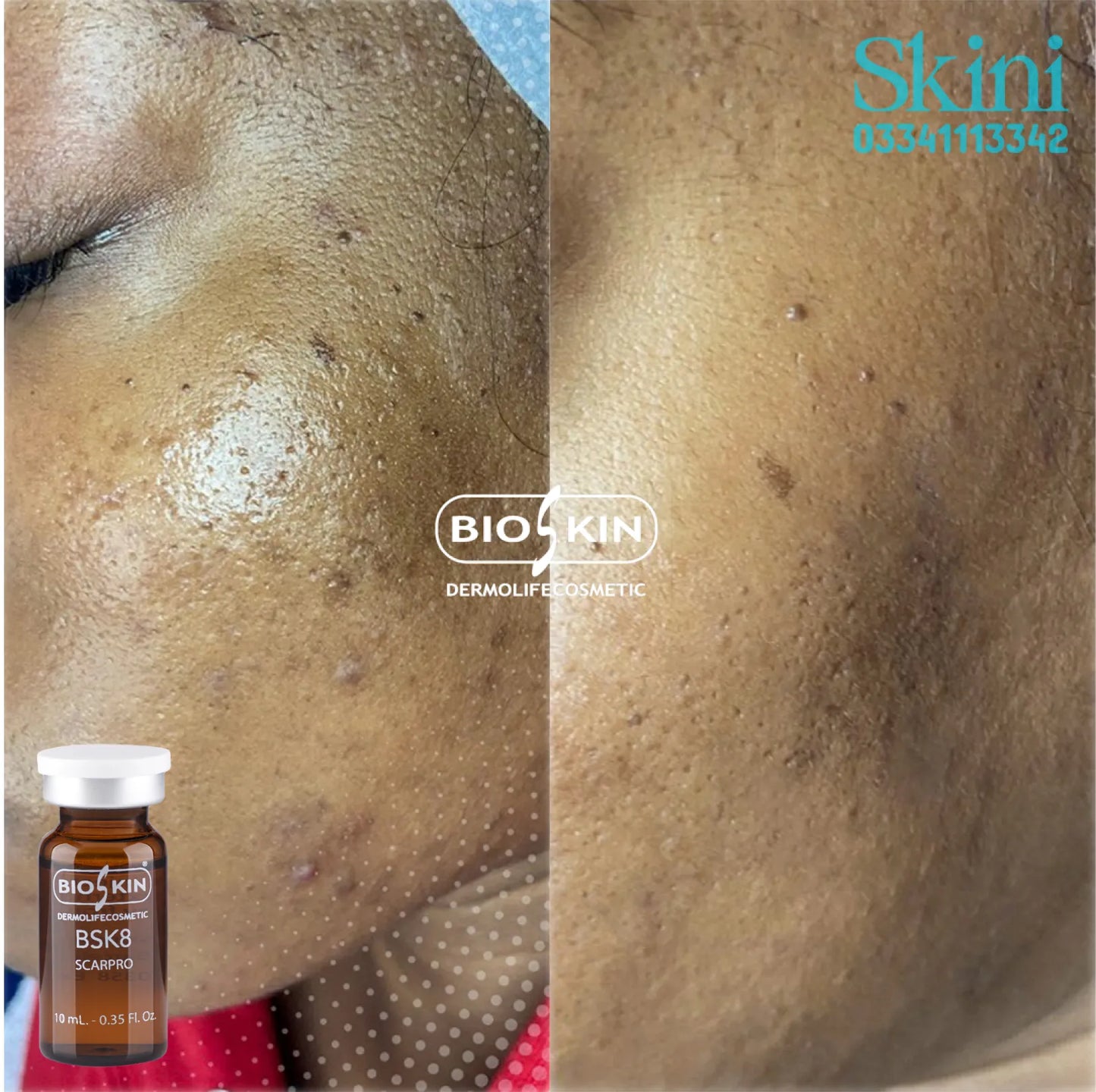 BioSkin Scar pro BSK8 - Made in Spain - Acne Scar Removal