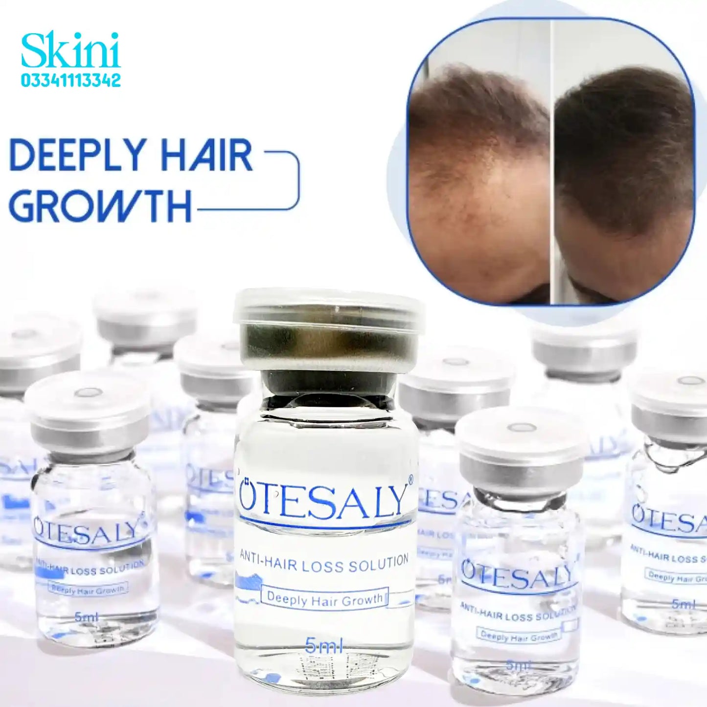 Otesaly Anti-Hair Loss Solution - Hair Growth Meso Serum