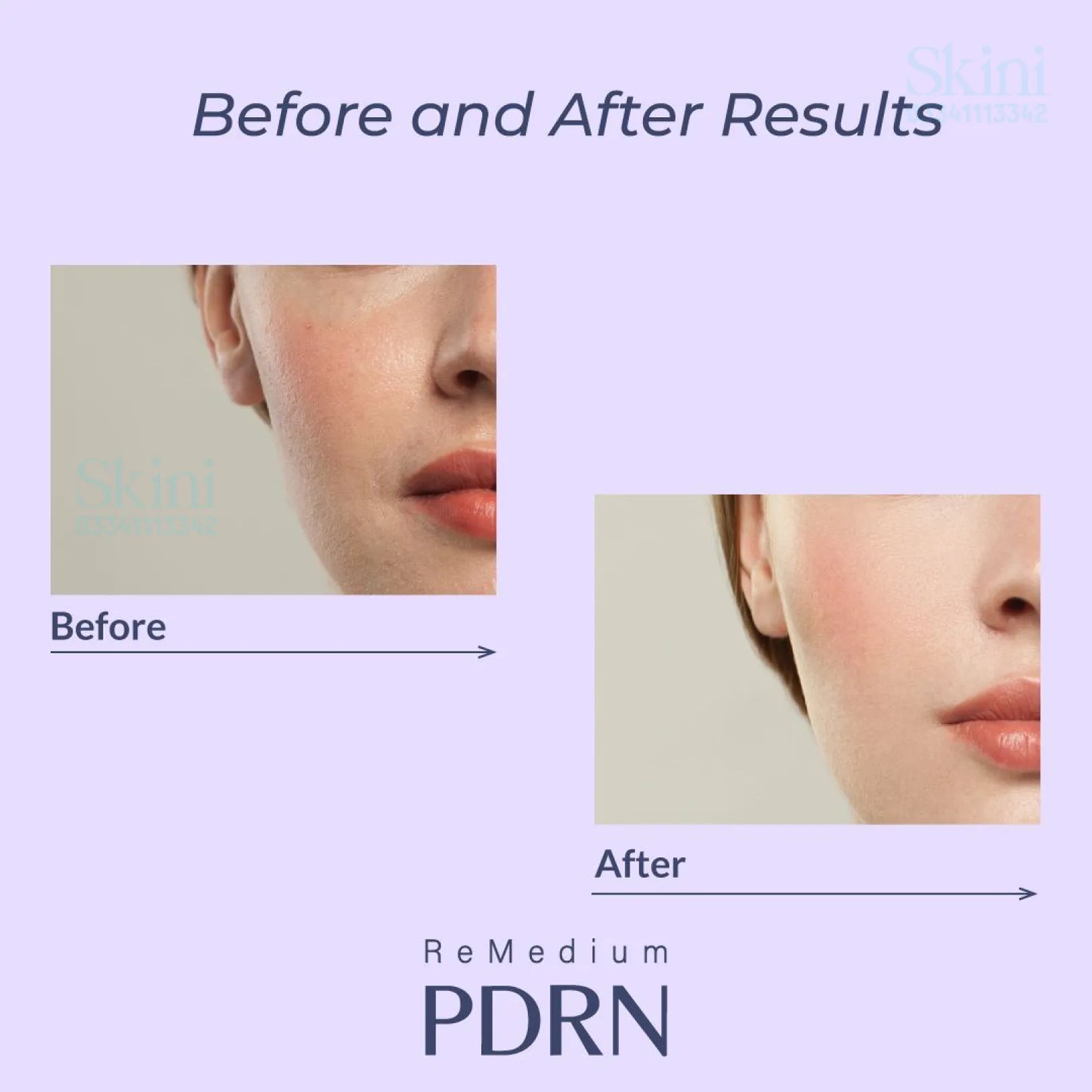 ReMedium PDRN | Best Korean PDRN Skin Rejuvenation | 2.2ml × 3